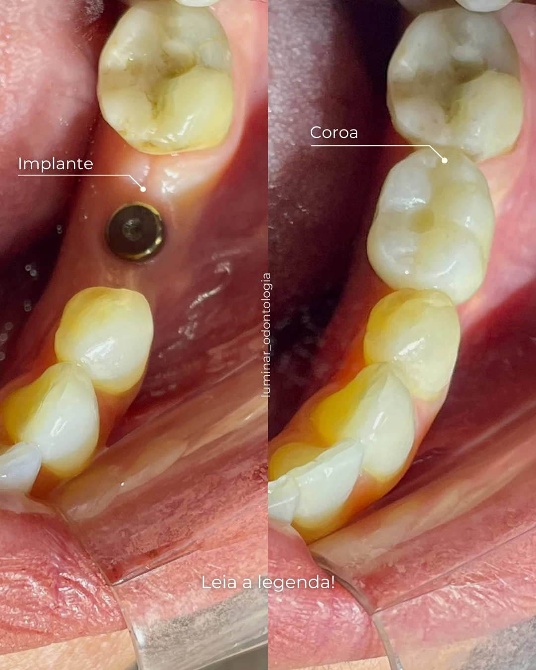 Caso clínico de coroa sobre implante em vista oclusal
