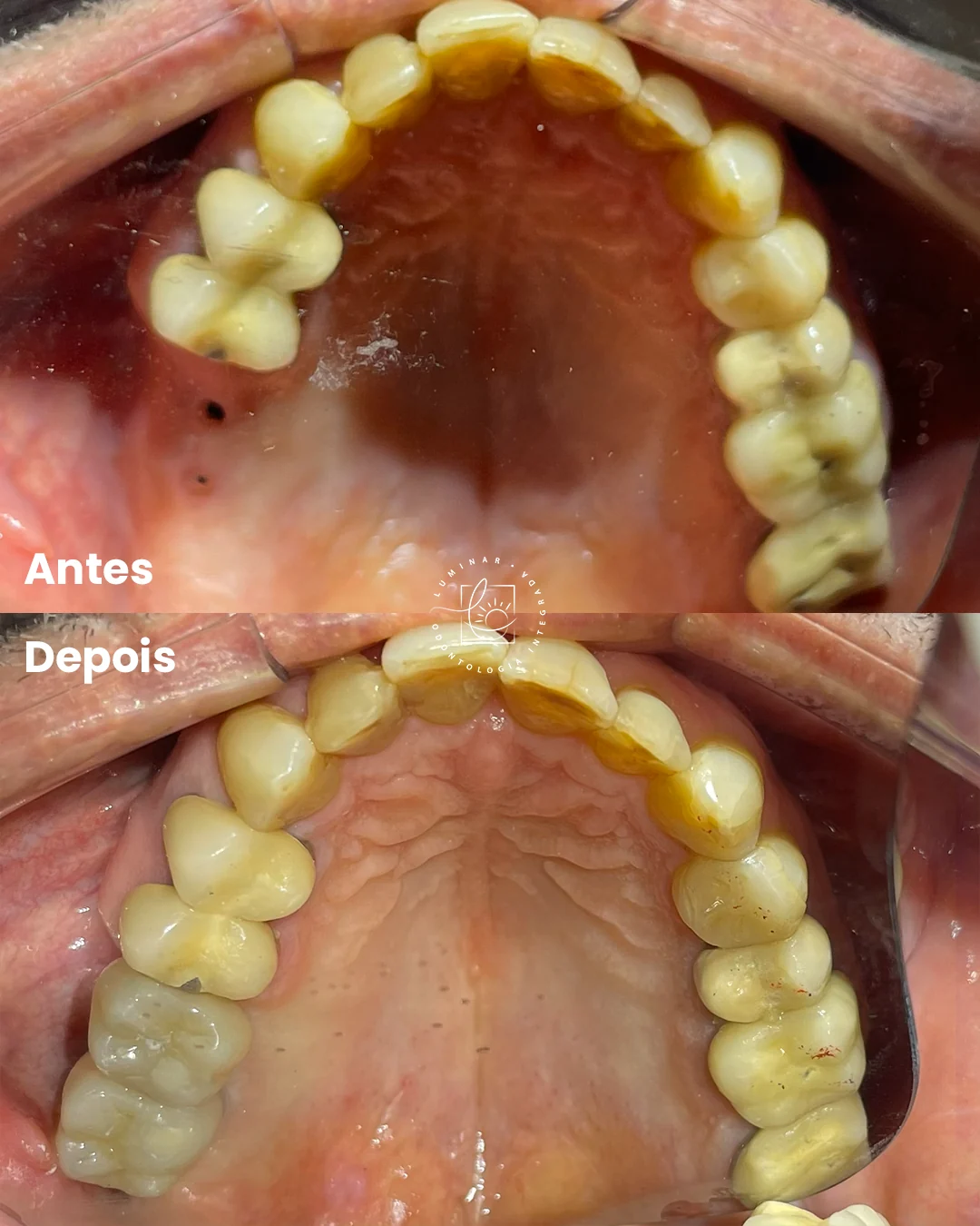 Caso clínico de antes e depois da arcada superior